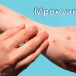 नए Mpox वैरिएंट ने दी दस्तक: फ्रांस में पहला केस, स्वास्थ्य अधिकारी सतर्क